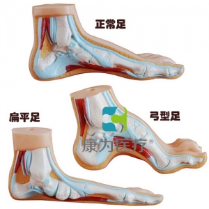 “康為醫(yī)療”正常足、扁平足、弓型足模型
