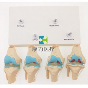 “康為醫(yī)療”四階段病變膝關(guān)節(jié)模型，4階段膝關(guān)節(jié)模型