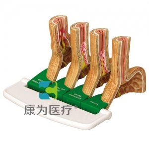 “康為醫(yī)療”醫(yī)患關系溝通模型-胃食管反流?。℅ERD）模型 （醫(yī)學指導模型）